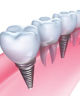 Fiche-Implant-1