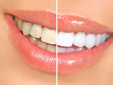 dents-tachees-ou-jaunies-2